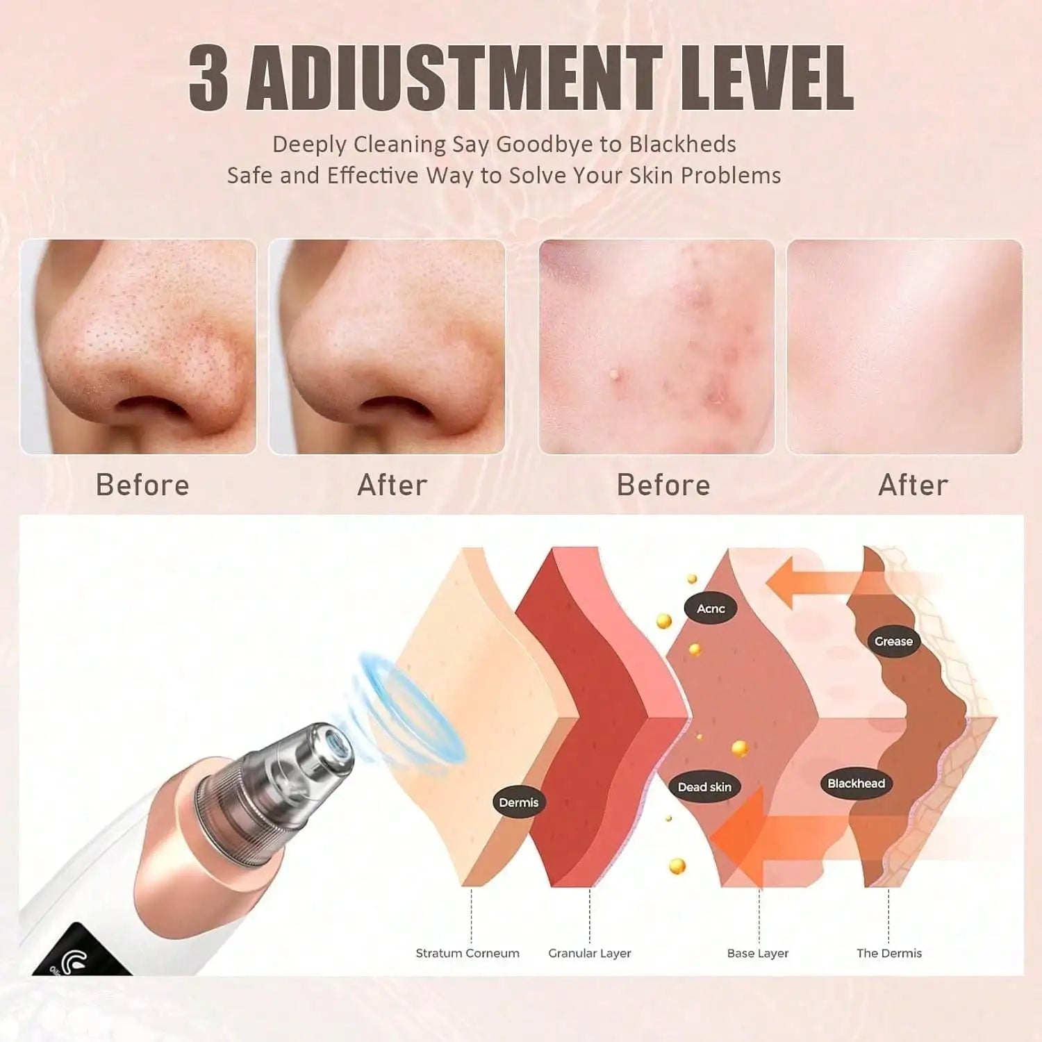 Zorivo™️ PureVac Pro.  (Zorivo™️ SkinClear Pro Luxury Pore Cleansing Device)